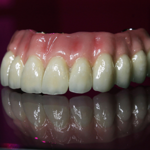 ZIRCONIA LAYERED (10 YRS)